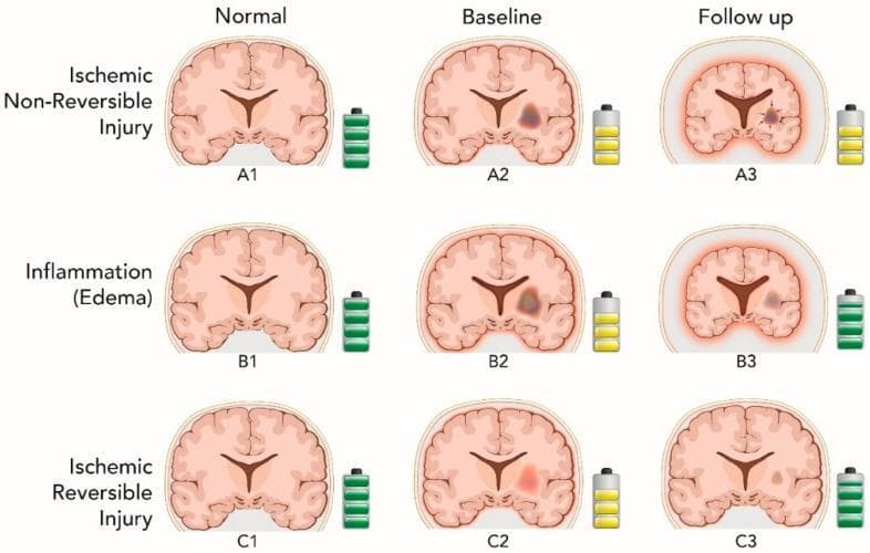 This Comparison Chart illustrates three conceptual pathophysiology mechanisms explaining White Matter Hyperintensity (WMH) regression and its impact on brain volume and cognitive performance. The diagram is organized into a 3x3 grid across categories of injury: Ischemic Non-Reversible (Row A), Inflammation/Edema (Row B), and Ischemic Reversible (Row C), tracked from 'Normal' to 'Baseline' to 'Follow up.' Battery icons adjacent to each brain signify cognitive performance levels. Row A demonstrates mechanical lesion contraction (black arrows in A3) leading to reduced overall brain volume (atrophy) with stagnant cognitive performance. Row B shows WMH resolution as edema clears, also resulting in decreased brain volume but showing cognitive improvement. Row C illustrates the most favorable outcome, where WMH volume regresses while both global brain volume and cognitive performance increase, suggesting neural recovery. Key visual elements include the relative sizing of brain outlines to represent atrophy or expansion and the intensity of periventricular/subcortical shading to represent WMH lesions.