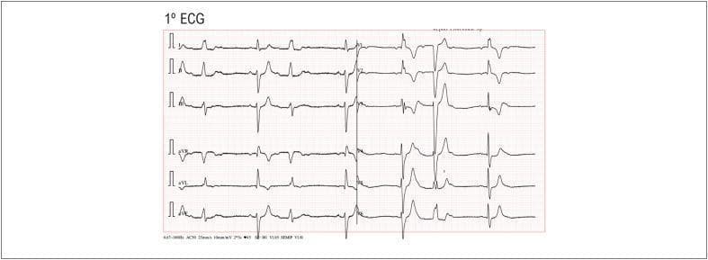 This diagnostic image is a 12-lead electrocardiogram (ECG) demonstrating a rare cardiac conduction phenomenon known as alternating bundle branch block. The rhythm strips show a beat-to-beat alternation of QRS morphology. One beat displays characteristics of a Right Bundle Branch Block (RBBB), characterized by an rsR' pattern in lead V1 and slurred S waves in lateral leads (I, aVL, V6), while the subsequent beat shifts to a Left Bundle Branch Block (LBBB) morphology, featuring broad, monophasic R waves in lateral leads and deep S waves in right precordial leads. In addition to the intraventricular conduction delay, the ECG reveals a concomitant second-degree atrioventricular (AV) block, Mobitz type I (Wenckebach). This is evidenced by progressive PR interval prolongation across successive beats until a P wave fails to conduct to the ventricles (dropped QRS complex). The combination of alternating bundle branch block and AV node disease signifies extensive, multilevel disease within the His-Purkinje system, carrying a high clinical significance due to the risk of progression to complete heart block.