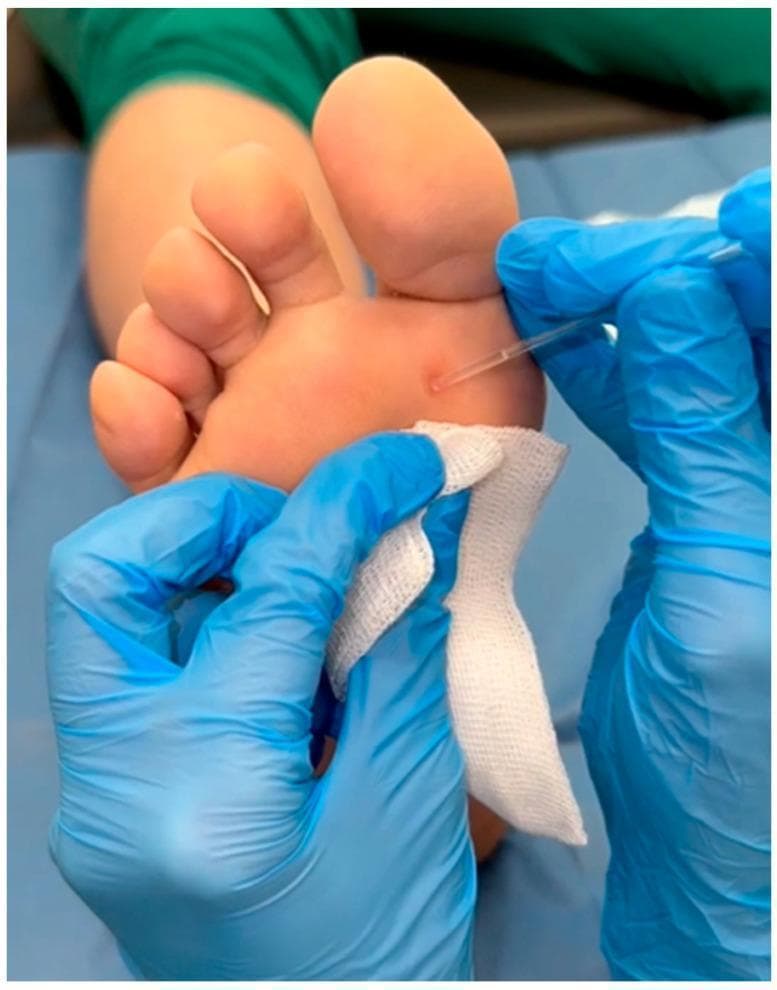 A close-up clinical photograph demonstrating a dermatological procedure on the plantar surface of a human foot. The image shows a small, localized, hyperkeratotic lesion—identified as a plantar wart (verruca plantaris)—located on the forefoot near the base of the first metatarsal head. The lesion is approximately 2-3 mm in diameter, circular, and slightly darker than the surrounding healthy skin. A healthcare professional wearing blue nitrile gloves is shown performing a topical treatment application. A thin, clear plastic capillary applicator is being used to precisely apply a liquid medicinal substance (nitric-zinc complex) directly onto the surface of the wart. A piece of sterile white gauze is held beneath the treatment site to catch excess fluid and protect the surrounding skin. The clinical focus is on targeted chemical cauterization or topical therapy for common viral warts in a primary care or podiatric setting.