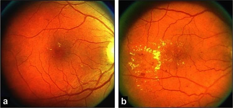 This diagnostic image pair displays side-by-side color fundus photographs used for the classification and grading of diabetic retinopathy according to ETDRS standards. Image (a) represents ETDRS standard photograph 3, showing a posterior pole with a healthy orange-red retinal background, visible retinal vasculature, and a clear optic disc. A few scattered, small, yellowish-white hard exudates are visible in the temporal macula, indicating early-stage lipid leakage. Image (b) represents ETDRS standard photograph 4, demonstrating a more advanced severity of hard exudates. A large, dense, circinate-like cluster of bright yellow-white hard exudates occupies the central macular area, significantly obscuring underlying retinal details. These images serve as reference standards for grading the area of retina involved by hard exudates (HE) in clinical trials and diagnostic assessments of non-proliferative diabetic retinopathy (NPDR). The comparison illustrates the progression of vascular permeability and lipid deposition characteristic of diabetic maculopathy.
