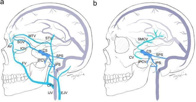 Two-panel anatomical diagram illustrating venous access routes for transvenous cavernous sinus (CS) embolization. Panel (a) highlights superficial venous pathways, showing the angular vein (AV) connecting to the superior ophthalmic vein (SOV), inferior ophthalmic vein (IOV), and facial vein (FV). The facial vein merges into the common facial vein (CFV) before draining into the internal jugular vein (IJV) and external jugular vein (EJV). Other highlighted superficial vessels include the middle temporal vein (MTV) and superficial temporal vein (STV). Panel (b) illustrates intracranial venous access routes, highlighting the cortical veins (CV) and superficial middle cerebral vein (SMCV) as they drain into the cavernous sinus. Both panels depict deep connections through the superior petrosal sinus (SPS), inferior petrosal sinus (IPS), and inferior petroclival vein (IPCV) as primary drainage pathways toward the jugular system. This medical illustration is designed to guide endovascular planning for treating carotid-cavernous fistulas or dural arteriovenous fistulas by identifying surgical and endovascular approach routes.