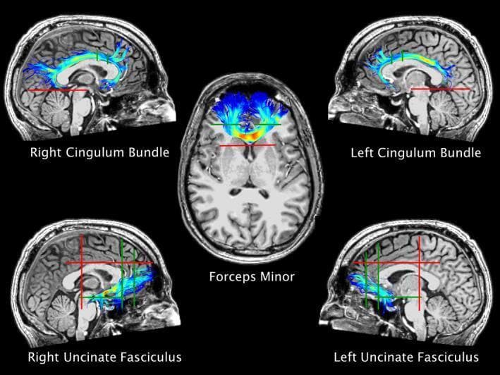 This diagnostic image set showcases Diffusion Tensor Imaging (DTI) tractography of white matter bundles in a template human brain. The figure consists of five panels: four sagittal views and one central axial view, each displaying specific fiber tracts overlaid on a T1-weighted anatomical grayscale background. The sagittal views highlight the bilateral Cingulum Bundles (top) following the curvature above the corpus callosum, and the bilateral Uncinate Fasciculi (bottom) connecting the temporal and frontal lobes. The central axial view depicts the Forceps Minor, extending through the genu of the corpus callosum. The tracts are color-coded with a blue-to-yellow gradient, representing fiber orientation or streamline density. Superimposed red and green straight lines denote 'NOT-regions of interest (ROIs)' and 'AND-ROIs' respectively, which are used as anatomical constraints for the deterministic or probabilistic tractography algorithms. This visualization is essential for neuroanatomical education and clinical research into traumatic brain injury (TBI) and white matter integrity.