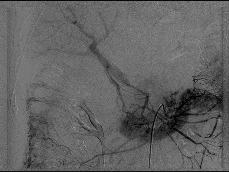 This diagnostic image is a splenoportogram (venous phase) illustrating acute portal vein thrombosis. The radiograph reveals a total lack of contrast enhancement in the main portal vein and the confluence of the superior mesenteric and splenic veins, indicating a complete vascular occlusion at this anatomical site. Significant findings include the absence of physiological venous return to the liver through the primary portal system. Instead, the image demonstrates extensive compensatory mechanisms, characterized by the visualization of numerous tortuous collateral vessels and small collateral veins providing alternative routes for venous drainage. The study highlights the diagnostic features of acute venous obstruction in the hepatobiliary system, which in this clinical context led to mesenteric ischemia. The image is a critical educational resource for understanding mesenteric vascular anatomy, pathological thrombus localization, and the secondary development of collateral circulation in response to portal hypertension or acute occlusion.