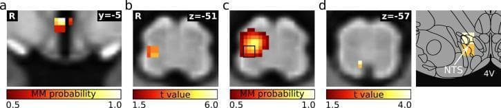 This composite diagnostic image displays functional magnetic resonance imaging (fMRI) data mapping cardiovascular regulatory centers in the human hypothalamus and brainstem. Panel (a) shows a hypothalamic cluster encompassing the paraventricular nucleus (PVN) and posterior hypothalamic area (PH) in a coronal view (y=-5). Panels (b), (c), and (d) utilize axial slices of the medulla oblongata to demonstrate connectivity changes during lower body negative pressure (LBNP). Panel (b) illustrates increased functional connectivity between the hypothalamus and a cluster in the lateral medulla (z=-51), including the rostral ventrolateral medulla (RVLM) and nucleus ambiguus (Amb), represented by t-values. Panel (c) shows a matched independent component (mICA) probability map identifying this functional cluster. Panel (d) reveals increased functional connectivity within the medulla (z=-57), specifically targeting the nucleus of the solitary tract (NTS), as further detailed in the accompanying anatomical diagram. The color scales indicate statistical significance (t-values from 1.5 to 6.0) or mixture model (MM) probability (0.5 to 1.0). This material serves to illustrate central baroreflex pathways and autonomic nervous system regulation.