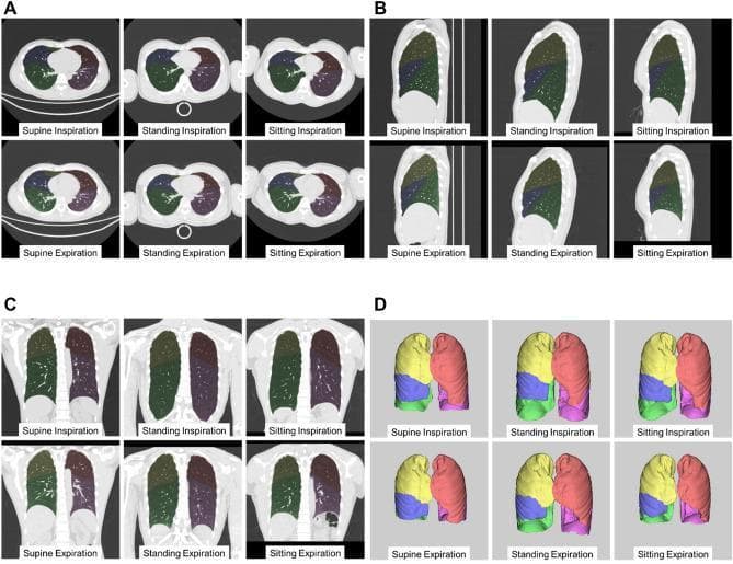 This diagnostic imaging composite displays multi-planar CT reconstructions and 3D volume-rendered models of the human lungs to illustrate anatomical changes across breathing phases and body positions. The image is organized into four panels: axial (A), sagittal (B), coronal (C), and 3D volume rendering (D). Each panel compares 'Inspiration' and 'Expiration' phases across three postures: supine, standing, and sitting. The lung lobes are color-coded for identification: the right upper lobe (yellow), right middle lobe (blue), right lower lobe (green), left upper lobe (pink), and left lower lobe (purple). The visuals demonstrate significant vertical expansion and increased lung height during inspiration compared to expiration. In the upright positions (standing and sitting), the lungs show altered morphology compared to the supine position due to gravitational effects on the diaphragm and thoracic contents. The volume-rendered models in panel D highlight the relative volumetric changes of individual lobes, showing that the lower lobes exhibit the greatest expansion during inspiration. This educational material is designed to teach respiratory mechanics, gravitational physiology, and the clinical utility of upright CT imaging in pulmonary assessment.