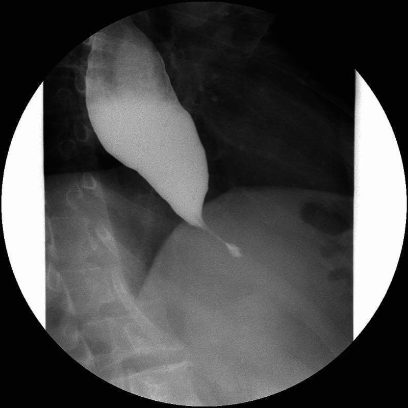 This diagnostic image is a contrast esophagogram (barium swallow) of the upper gastrointestinal tract. The radiograph reveals a significantly dilated esophagus filled with radiopaque barium contrast. There is a classic 'bird's beak' appearance at the distal esophagus, characterized by a smooth, symmetric, and tapered narrowing as the lumen approaches the gastroesophageal junction. This radiographic finding is pathognomonic for achalasia, reflecting the failure of the lower esophageal sphincter (LES) to relax and the loss of esophageal peristalsis. The contrast outlines a clear transition from the proximal megaesophagus to the functional obstruction at the cardia. This image is a primary educational tool for illustrating the diagnostic features of esophageal motility disorders in gastroenterology and radiology. It demonstrates the clinical significance of barium studies in evaluating patients presenting with symptoms such as dysphagia, regurgitation, and weight loss.