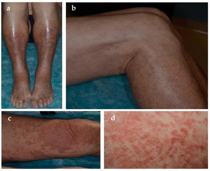 This composite of four clinical photographs (a–d) illustrates Schamberg disease, the most common form of pigmented purpuric dermatosis (PPD). Images (a) and (b) display a bilateral, diffuse distribution of skin lesions across the lower legs and feet. The primary visible feature is a persistent yellow-orange-brown discoloration caused by hemosiderin deposition, frequently associated with underlying venous hypertension. Overlaid on these hyperpigmented patches are numerous pinpoint, non-blanching petechiae, often described as having a 'cayenne pepper' appearance. Images (c) and (d) provide closer views of discrete yellow-red patches with dense, superimposed petechial spots, demonstrating the active inflammatory phase of the condition. The educational focus is on the characteristic morphology and color progression of PPD, which typically presents as chronic, asymptomatic macules and patches on the lower extremities. This visual material is relevant for dermatology training, emphasizing the clinical diagnosis of capillaritis and its differentiation from other purpuric or vasculitic conditions.