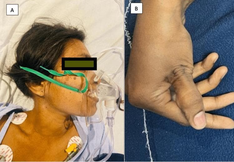 This composite clinical photograph illustrates acute neuromuscular manifestations of tetany. Image A shows a female patient in a supine position under intensive monitoring, featuring a high-flow oxygen mask (simple face mask) secured with a green strap. Visible clinical support includes multiple electrocardiogram (ECG) chest leads for cardiac monitoring, indicative of an acute medical emergency such as severe laryngospasm. Image B provides a close-up of a carpopedal spasm, a hallmark sign of hypocalcemia-induced tetany. The hand displays characteristic adduction of the thumb, flexion at the wrist and metacarpophalangeal joints, and extension at the interphalangeal joints (often referred to as 'main d'accoucheur' or obstetrician's hand). This visual documentation is critical for medical education in recognizing the physical signs of acute electrolyte imbalances, such as hypocalcemia or respiratory alkalosis, and the secondary complications like laryngospasm requiring immediate airway management and intensive care.