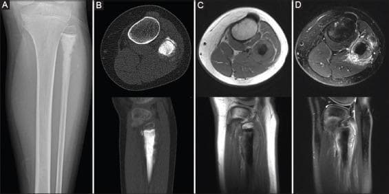 This composite diagnostic image illustrates a primary osteosarcoma in the left proximal fibula of a 10-year-old patient across four imaging modalities. (A) Plain radiograph demonstrates 'cloud-like' osteogenic destruction of the medullary and cortical bone, a suspicious soft tissue mass, and a Codman triangle, indicating aggressive periosteal reaction. (B) Transverse and sagittal CT scans provide high-resolution detail of the mineralized matrix and cortical destruction, including a visible lamellate periosteal reaction. (C) T1-weighted MRI (axial and coronal) shows the tumor with low signal intensity in the mineralized medullary compartment and intermediate signal in the non-mineralized soft-tissue component. (D) T2-weighted MRI (axial and coronal) highlights the heterogeneity of the lesion; the mineralized areas remain low signal, while non-mineralized soft tissue shows medium-high signal intensity, accompanied by high signal intensity peritumoral edema. These modalities collectively facilitate the assessment of tumor mineralization, soft tissue extension, and involvement of surrounding neurovascular structures for surgical planning.