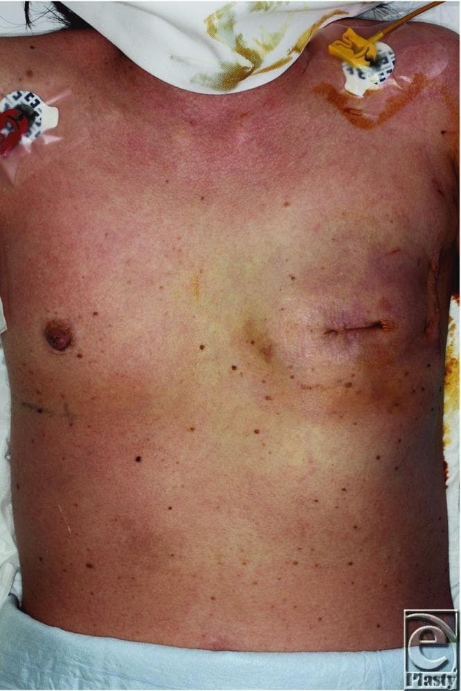 Clinical photograph of a 54-year-old female patient's anterior torso demonstrating a diffuse, erythematous macular rash on the chest and abdomen. The skin exhibits confluent redness, characteristic of a systemic inflammatory or toxic response. Anatomically, the left breast region shows evidence of recent surgery (mastectomy/reconstruction) with a visible surgical incision and suture lines. On the right and left infraclavicular regions, central venous access devices or monitoring lines are present, secured with adhesive dressings. Notably, the right-sided insertion site shows peri-catheter reddish-brown staining. Multiple small, benign-appearing pigmented nevi are scattered across the trunk. This visual presentation, in the context of postoperative fever and hypotension, is clinically representative of Toxic Shock Syndrome (TSS) following breast surgery and tissue expander placement. The image serves as an educational example of early-onset postoperative TSS manifestations, emphasizing the appearance of the classic diffuse scarlatiniform eruption.