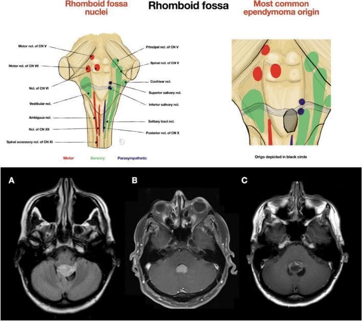 Educational medical composite image focusing on the neuroanatomy of the rhomboid fossa and its relationship to ependymoma. The upper section contains two anatomical diagrams: the left depicts the cranial nerve nuclei of the rhomboid fossa, color-coded by function (Motor in red, Sensory in green, Parasympathetic in blue). Key structures include motor nuclei of CN V, VI, VII, and XII; sensory nuclei like the vestibular and solitary tract; and parasympathetic salivary nuclei. The right diagram highlights the 'Most common ependymoma origin' located in the inferior portion of the fourth ventricle, medially near the obex. The bottom section displays three axial MRI brain images (A, B, C) showing variations in ependymoma presentation within the fourth ventricle. Image (A) shows an asymmetrical tumor extending laterally into the left foramen of Luschka. Images (B) and (C) demonstrate midline-restricted tumors. This clinical illustration serves to teach neurosurgical planning, showing how tumor location relative to the rhomboid fossa and lateral foramina dictates craniotomy approach and surgical navigation.