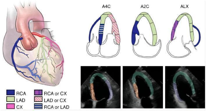 Educational medical diagram and diagnostic imagery illustrating left ventricular (LV) segmentation and coronary artery distribution based on 2015 ASE guidelines. The graphic includes an anatomical heart illustration, schematic apical views, and corresponding echocardiographic frames. The anatomical diagram color-codes the Right Coronary Artery (RCA, blue), Left Anterior Descending artery (LAD, green), and Circumflex artery (CX, pink), with striped patterns indicating overlapping territories. Three schematic diagrams represent standard echocardiographic planes: Apical Four-Chamber (A4C), Apical Two-Chamber (A2C), and Apical Long-Axis (ALX), mapping coronary blood supply to specific LV myocardial segments. Below these, three transthoracic echocardiogram frames demonstrate automated segmentation masks: Region A (apical, anterior, and anteroseptal walls) in green, Region F (inferior and inferoseptal walls) in orange, and Region L (anterolateral and inferolateral walls) in purple. This visual resource is designed to teach the correlation between coronary anatomy and regional wall motion territories in cardiac imaging.