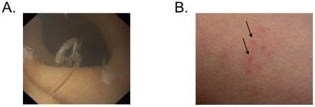 This composite clinical figure illustrates different stages and manifestations of a human hookworm infection. Panel A presents an endoscopic image of the upper gastrointestinal tract, demonstrating a mature adult hookworm attached to the intestinal mucosa. The worm is characterized by an elongated, curved, and semi-translucent body morphology. Panel B is a clinical photograph showing the percutaneous inoculation site on light-pigmented skin. It features several small, erythematous, inflammatory papules (indicated by black arrows) representing the localized cutaneous reaction to the penetration of hookworm larvae (L3 stage). The images serve to illustrate the visual findings associated with parasitic helminth infection, from initial larval entry to adult colonization of the intestine. This content is relevant for gastroenterology and infectious disease training, focusing on the diagnosis of hookworm (Ancylostoma or Necator species) through endoscopy and physical examination of skin lesions (ground itch).