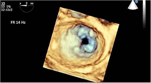 This diagnostic image is a 3D full-volume transesophageal echocardiogram (TEE) demonstrating a ‘surgeon’s view’ (en face from the left atrium) of the mitral valve. The image illustrates classic features of rheumatic heart disease. The mitral valve exhibits significant leaflet thickening and restricted mobility, resulting in a characteristic 'fish mouth' appearance of the valve orifice during diastole. This morphology is primarily caused by extensive commissural fusion, particularly involving the anterolateral commissure, and tethering of the leaflets. These visual findings are diagnostic markers for rheumatic mitral stenosis. The echocardiographic modality provides high spatial resolution (FR 14 Hz) necessary for pre-surgical planning and assessing the extent of valvular deformity. Key anatomical structures visible include the fused anterior and posterior mitral valve leaflets and the stenotic central orifice.