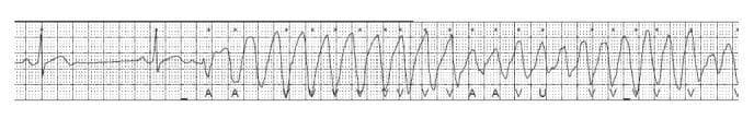 This diagnostic image is a continuous telemetric electrocardiogram (ECG) strip demonstrating the acute onset of a life-threatening ventricular arrhythmia. The tracing begins on the left with a normal sinus rhythm showing identifiable P waves and narrow QRS complexes. It then abruptly transitions into a polymorphic ventricular tachycardia (PVT) specifically characterized as Torsades de Pointes (TdP). The arrhythmia is defined by rapid, wide-complex QRS morphology with a characteristic 'twisting' of the peaks around the isoelectric baseline. The waveform exhibits cyclical variations in amplitude and polarity, transitioning from positive to negative deflections. This visual pattern illustrates the typical progression of a drug-induced or electrolyte-related QT prolongation leading to triggered activity. The recording serves as a classic educational example of PVT, highlighting the loss of organized atrial activity and the transition from stable rhythm to unstable ventricular tachyarrhythmia, which is clinically significant in emergency medicine and cardiology for identifying risks of sudden cardiac death.