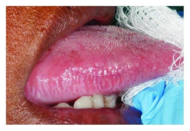 This clinical intraoral photograph displays a localized white lesion on the lateral border of the tongue, characteristic of oral hairy leukoplakia. The lesion is primarily hyperkeratotic and exhibits a distinct corrugated or 'hairy' surface texture with prominent vertical ridges. It is situated along the right lateral margin, showing a clear demarcation from the surrounding normal, pinkish-red tongue mucosa. The image provides clinical context for evaluating opportunistic infections in immunocompromised patients, specifically those with HIV/AIDS. The presence of these vertically oriented white plaques is strongly associated with Epstein-Barr virus (EBV) replication within the oral epithelium. Educational focus includes recognizing the morphology, anatomical site predilection, and clinical significance of this benign but diagnostic marker of immune suppression.