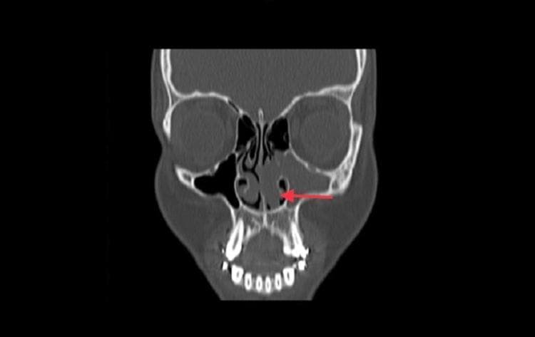This diagnostic image is a non-contrast coronal CT scan of the paranasal sinuses demonstrating a large left-sided antrochoanal polyp. The left maxillary sinus shows total opacification and mild bony remodeling. This opacification extends through a significantly widened left maxillary ostium (indicated by a red arrow) into the left nasal cavity, representing the typical 'dumbbell' configuration of an antrochoanal polyp. Within the nasal cavity, a large polypoidal soft tissue mass obstructs the middle and inferior meatus, causing displacement of the left inferior turbinate and partial opacification of the middle meatus. The left uncinate process and hiatus semilunaris are obscured by mucosal thickening. The nasal septum is deviated toward the right. In contrast, the right maxillary sinus, ostium, and ethmoid air cells are clear and well-pneumatized, providing a healthy anatomical comparison. This image serves as a classic educational example of sinonasal polyposis and obstructive sinus pathology in otolaryngology.