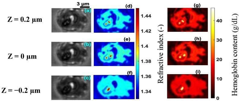Microscopic analysis of a human red blood cell (RBC) infected with Plasmodium falciparum at the schizont stage. The image presents a 3x3 grid comparing brightfield images (a–c), reconstructed 3D refractive index (RI) distributions (d–f), and hemoglobin content maps (g–i) across three z-planes (z = 0.2 μm, 0 μm, and -0.2 μm). The brightfield images show a distorted cell morphology consistent with advanced parasitic infection. The refractive index maps (d–f) utilize a color scale from 1.34 to 1.44; high RI focal points (yellow-red, RI > 1.42) identify localized hemozoin crystals, the byproduct of hemoglobin digestion. The hemoglobin content maps (g–i) use a quantitative color scale from 0 to 45 g/dL, highlighting asymmetric, depleted hemoglobin distribution (red-to-yellow) compared to healthy RBCs. Spatial variations across the z-planes demonstrate the heterogeneous internal structure of the parasitized cell, including the presence of multiple merozoites and metabolic waste within the host cytoplasm. This visualization is used in hematology and infectious disease research to quantify biochemical and morphological changes during the intra-erythrocytic cycle of malaria.