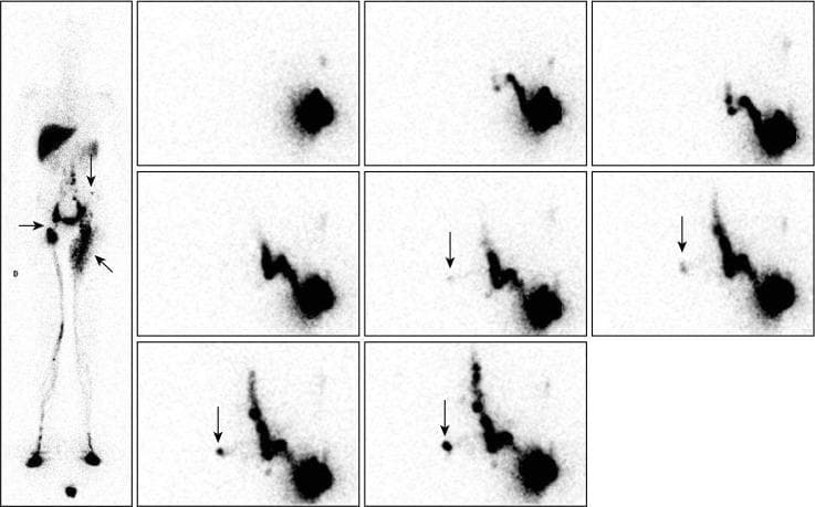 This composite diagnostic image features Phase 3 and Phase 4 99mTc-nanocolloid lymphoscintigraphy of a 13-year-old patient with primary lower limb lymphedema. The left panel shows an anterior whole-body scan (WBS) obtained after walking. It illustrates tracer progression from the feet. The right limb displays a horizontal arrow marking an inguinal nodal gap and decreased uptake in the common iliac and lumbo-aortic chains. The left limb shows lymphatic reflux toward the superficial dermal network of the thigh (oblique arrow) and an isolated lymph node in the left flank (vertical arrow). The right panel comprises a sequence of eight static images centered on the pelvis/abdomen following a supplemental intradermal injection in the left external buttock. This sequence demonstrates abnormal collateral drainage pathways: a lymphatic vessel (marked by vertical arrows) is seen crossing the anterior midline from the left inguinocrural region toward the right inguinal area, eventually reaching a contralateral inguinal lymph node. These findings characterize collateral lymphatic compensation in the setting of primary lymphatic insufficiency.