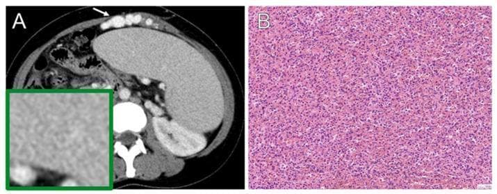 A composite image consisting of a diagnostic radiological scan and a histopathological photomicrograph illustrating congestive splenomegaly. Image (A) is an axial contrast-enhanced CT scan of the abdomen showing significant, diffuse, homogeneous enlargement of the spleen (splenomegaly). The splenic parenchyma maintains a uniform enhancement pattern. Prominent portosystemic varices are visible along the anterior abdominal wall (indicated by a white arrow), suggesting portal hypertension. A green-bordered inset provides a magnified view of the uniform splenic texture. Image (B) is a light microscopy photomicrograph of splenic tissue stained with Hematoxylin and Eosin (H-E). The histology demonstrates features of chronic passive congestion, characterized by marked engorgement of the splenic sinuses and parenchyma with red blood cells (erythrocytes). The cellular architecture remains largely intact but displays a dense, congested appearance. This educational material correlates gross radiological findings of organomegaly and vascular shunting with microscopic evidence of vascular congestion, typically associated with conditions like portal hypertension or congestive heart failure.