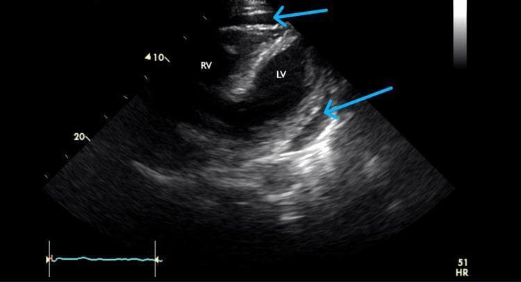 A subcostal four-chamber view echocardiogram demonstrating a moderate circumferential pericardial effusion. The image shows the anatomical arrangement of the heart with the right ventricle (RV) positioned anteriorly, closest to the transducer at the top of the sector, and the left ventricle (LV) located posteriorly. The pericardial effusion is clearly visualized as an anechoic (dark), echo-free space surrounding the myocardium, indicated by blue arrows. This dark space creates a distinct separation between the echogenic (bright) pericardium and the heart tissue. This imaging modality is essential for evaluating pericardial fluid volume and assessing for signs of cardiac tamponade, such as diastolic collapse of the right heart chambers. The subcostal view is particularly useful in clinical practice for visualizing the effusion through the acoustic window provided by the liver.