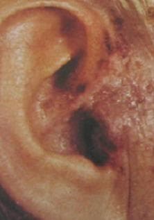 This clinical photograph shows a close-up of the right external ear and preauricular region exhibiting characteristic features of Ramsay Hunt syndrome (herpes zoster oticus). The image displays a cluster of small, fluid-filled vesicles on an erythematous base. These herpetic lesions are localized to the pinna and the external auditory canal entrance, which corresponds to the sensory distribution of the facial nerve (cranial nerve VII). Some vesicles appear intact with clear fluid, while others show signs of early crusting or rupture. The surrounding skin exhibits diffuse erythema and mild edema. This presentation is medically significant for medical students and clinicians as it illustrates the typical cutaneous manifestations of varicella-zoster virus reactivation involving the geniculate ganglion. Key educational points include the recognition of dermatomal vesicular rashes and their association with otalgia and potential facial nerve palsy.