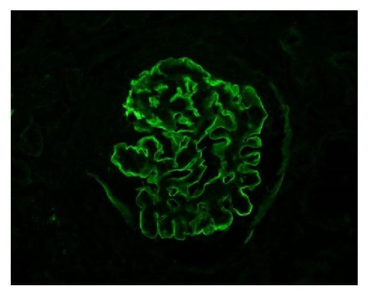 This diagnostic image is a high-power immunofluorescence (IF) microscopy of a human renal glomerulus. The image demonstrates a hallmark diagnostic pattern for anti-glomerular basement membrane (anti-GBM) disease. There is intense, continuous, and highly smooth linear staining for IgG (immunoglobulin G) along the glomerular capillary loops. Unlike the granular appearance typical of immune complex deposition (e.g., in lupus nephritis or post-infectious glomerulonephritis), this linear ribbon-like fluorescence highlights the entire circumference of the capillary basement membranes. The background is appropriately dark, emphasizing the bright green fluorescein isothiocyanate (FITC) signal. This visual finding is a key educational feature for identifying Goodpasture syndrome or anti-GBM mediated crescentic glomerulonephritis in a clinical pathology context. The pattern reflects the direct binding of autoantibodies to the non-collagenous domain of the alpha-3 chain of type IV collagen within the basement membrane.