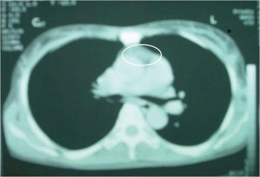 This diagnostic axial CT scan of the chest reveals a soft tissue mass located in the anterior mediastinum, indicated by a white elliptical annotation. The mass exhibits a lobulated morphology and is situated immediately posterior to the sternum and anterior to the great vessels and heart base. In this contrast-enhanced image, the mass shows minimal enhancement relative to the surrounding cardiovascular structures, suggesting low vascularity. Other visible anatomical landmarks include the thoracic vertebrae, bilateral lung fields, and the chest wall. Clinically, this imaging finding is representative of a differential diagnosis for anterior mediastinal tumors, such as thymoma, lymphoma, or a teratoma. The image is a primary resource for students learning to identify mediastinal compartment pathologies and radiological presentations of chest masses.