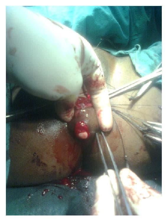 An intraoperative clinical photograph documenting a posterior sagittal anorectoplasty (PSARP) or similar anal transposition procedure for an anorectal malformation. The surgical field focuses on the perineum of a patient in the lithotomy position. A new anal opening has been surgically created through the identified striated muscle complex (sphincter). A gloved hand and surgical instruments, including fine-tipped forceps and hemostats, are visible manipulating the raw, vascularized perineal tissues. Stay sutures are in place to provide traction and exposure of the operative site. The image shows the newly formed ovoid opening with some internal mucosal or rectal tissue visible at the margins. Visible blood and tissue inflammation are consistent with an active surgical dissection. This visual illustrates the surgical management of imperforate anus or rectovestibular fistula in an adult patient, emphasizing the creation of a neo-anus within the sphincteric muscle complex.