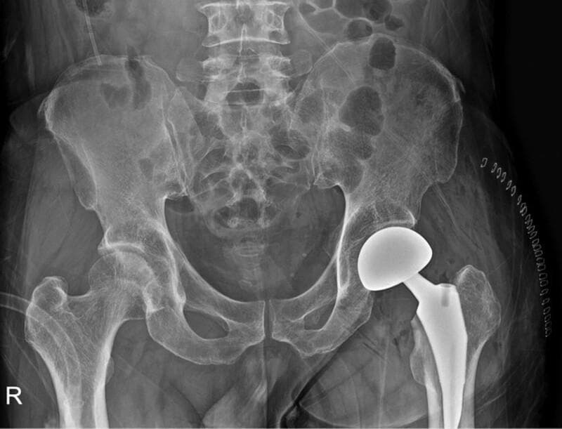 Anteroposterior (AP) radiograph of the pelvis and proximal femurs showing a left-sided hip bipolar hemiarthroplasty. The orthopedic implant consists of a radiopaque femoral stem securely fixed within the proximal femoral canal and a large, spherical prosthetic head articulating with the native acetabulum. The right hip joint appears intact and anatomically normal, providing a comparative reference. The pelvic ring, including the ilium, ischium, and pubis, is clearly visualized, along with the sacrum and lumbar vertebrae. Surgical skin staples are visible on the lateral aspect of the left thigh, indicating the recent operative approach. This diagnostic image is used to assess postoperative implant positioning, limb length alignment, and the absence of acute complications such as fracture or immediate dislocation. The visualization of the prosthetic head’s circular profile is a key clinical sign for confirming proper component orientation.