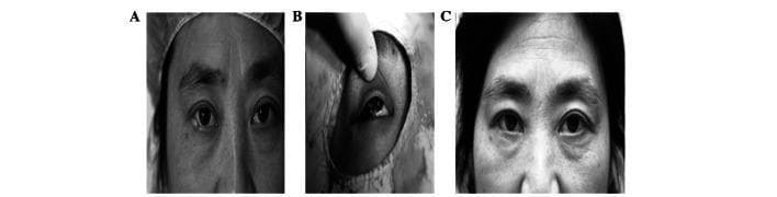 A series of three clinical photographs (A, B, C) documenting the surgical management of a right lower eyelid neoplasm. Panel A shows the preoperative frontal view of a patient with a localized lesion on the right lower eyelid margin. Panel B provides an intraoperative close-up of the right eye following tumor excision, revealing a large tarsal defect approximately half the length of the palpebral margin with visible sutures in the tarsal palpebral conjunctiva for reconstruction. Panel C displays the postoperative result three months after surgery. The image demonstrates successful anatomical restoration with preserved palpebral fissure symmetry (less than 2 mm difference in height and length compared to the contralateral side), normal eyelid closure, and the absence of complications such as entropion or ectropion. This clinical sequence illustrates effective ophthalmic reconstructive surgery following eyelid malignancy excision, focusing on functional and cosmetic outcomes in oculoplastics.