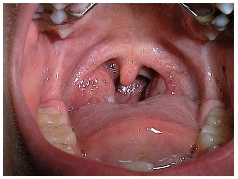 This clinical photograph displays an intraoral view of the oropharynx in a 6-year-old child, illustrating Grade III palatine tonsil hypertrophy. The tonsils are significantly enlarged and extend medially, occupying approximately 50% to 75% of the oropharyngeal airway width. The tonsillar tissue appears erythematous with visible surface crypts and an irregular morphology. This massive enlargement causes notable narrowing of the oropharyngeal space, with the central uvula appearing partially compressed between the two tonsillar masses. The surrounding structures, including the soft palate, posterior pharyngeal wall, and the base of the tongue, are clearly visible. Clinical significance includes the potential for upper airway obstruction, which is a major contributor to pediatric obstructive sleep apnea syndrome (OSAS). The image serves as a teaching tool for the Brodsky grading scale for tonsillar enlargement in pediatric otolaryngology.