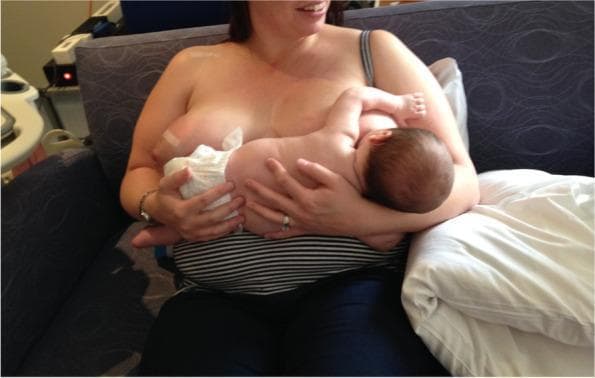 A clinical photograph depicting a mother and infant during a breastfeeding session, illustrating the 'gestalt' breastfeeding intervention for position and attachment. The infant is positioned in a modified cradle hold, latched onto the mother's left breast. The infant's body is aligned and supported by the mother's arms, with the head slightly tilted to facilitate a deep latch. The mother is seated on a dark blue couch, using a white pillow for additional lumbar or arm support. Notably, the infant appears to be breastfeeding with the assistance of a nipple shield, a common clinical tool used for managing nipple pain or latch difficulties. The mother's right breast is partially covered with white gauze, likely for milk collection or hygiene. The photograph serves as an educational resource in lactation consultancy and maternal-child health, demonstrating infant positioning, maternal support techniques, and the use of breastfeeding aids in cases involving neonatal oral connective tissue concerns or maternal nipple pain.