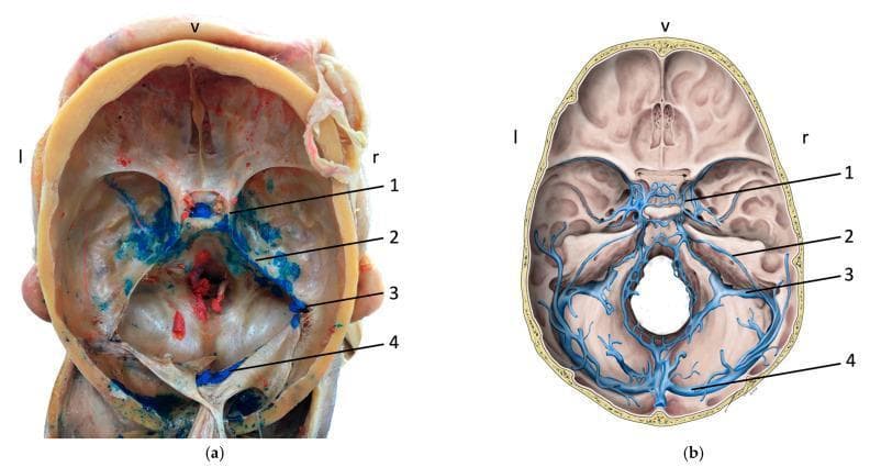 This medical image displays a comparative study of the cranial base dural venous sinuses through an anatomical cadaveric specimen and a corresponding schematic diagram. Panel (a) shows an internal view of a human skull base following calvaria and brain removal. The dural sinuses are highlighted by blue latex dispersion injected via the facial vein, demonstrating venous connections. Panel (b) provides an idealized anatomical illustration of the same structures. Key numbered structures in both panels include: (1) Cavernous sinus, located ventrally and centrally; (2) Superior petrosal sinus, extending posterolaterally along the petrous part of the temporal bone; (3) Sigmoid sinus, following an S-shaped course toward the jugular foramen; and (4) Transverse sinus, positioned most posteriorly within the tentorium cerebelli. Orientation markers indicate ventral (v), left (l), and right (r) directions. This content serves to teach the complex intracranial venous anatomy and the clinical significance of venous anastomoses between the extracranial facial veins and the intracranial dural sinus system, which is relevant for understanding the spread of infections or thrombi.