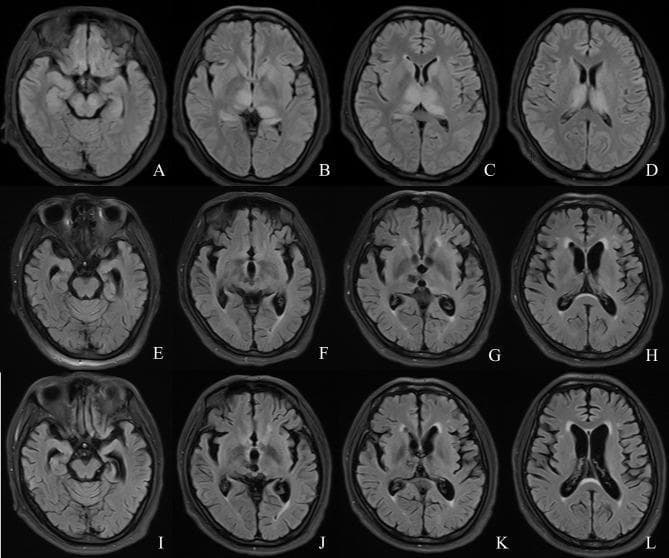 This diagnostic image is a longitudinal comparison of axial brain MRI scans (FLAIR sequence) across three time points: day 6 (A-D), month 6 (E-H), and month 14 (I-L). The initial scans (A-D) demonstrate acute bilateral, symmetrical hyperintense signals involving the thalami, caudate nuclei, lentiform nuclei, and hippocampi, characteristic of Japanese encephalitis or similar neuroinflammatory processes. In the subacute to chronic phase (E-H), these hyperintensities significantly regress; however, there is evidence of progressive global brain atrophy, characterized by compensatory enlargement of the lateral and third ventricles (ventriculomegaly) and widening of the cortical sulci. By month 14 (I-L), the atrophy has stabilized or slightly progressed, showing prominent ex-vacuo ventriculomegaly and advanced thinning of the brain parenchyma. The images illustrate the evolution from acute inflammatory lesions to chronic neurodegenerative changes and volume loss following severe viral encephalitis.