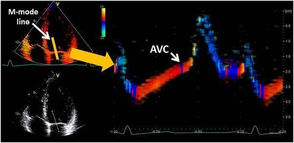 This composite diagnostic image demonstrates the use of color M-mode echocardiography to estimate cardiac timing intervals, specifically Aortic Valve Closure (AVC). The left side shows two apical 2D views of the heart: an upper color Doppler image and a lower grayscale 2D echocardiogram, highlighting the placement of the M-mode sampling line across the anterior mitral valve leaflet. The right side features a color-coded M-mode trace representing the movement and velocity of the mitral leaflet over time. In this trace, the red and blue color shifts indicate the direction and velocity of leaflet motion toward and away from the transducer. A critical educational feature is the 'AVC' label pointing to a distinct thin blue line at the peak of the systolic upstroke of the mitral leaflet. This visual marker serves as a surrogate for identifying the end of systole and the timing of aortic valve closure when direct visualization or spectral Doppler is unavailable. An integrated ECG trace at the bottom provides temporal correlation with the cardiac cycle.