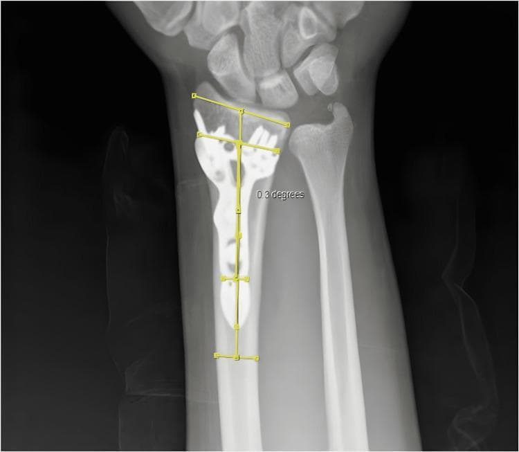 This diagnostic image is an anteroposterior (AP) X-ray of the wrist and distal forearm, demonstrating a distal radius fracture status post-open reduction and internal fixation (ORIF). A radiopaque locking plate is visualized along the volar aspect of the distal radius, secured with multiple cortical and locking screws. Yellow digital annotations illustrate a clinical measurement for coronal malposition known as the 'AYE Angle.' This measurement is obtained by calculating the angle between the vertical midline axis of the distal radius shaft and the longitudinal midline axis of the implanted hardware. In this specific case, the measurement is labeled as 0.3 degrees, indicating minimal coronal malalignment. The surrounding anatomy including the distal ulna, carpal bones, and radiocarpal joint space are well-visualized. This diagnostic tool is used in orthopedic surgery to assess the precision of hardware placement and post-operative alignment, which is critical for preventing complications like tendon irritation or restricted range of motion.