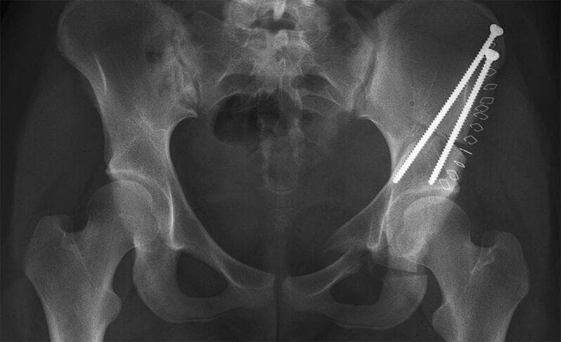 Anterior-posterior (AP) pelvic radiograph demonstrating the postoperative state of a minimally invasive periacetabular osteotomy (PAO) on the patient's right side (anatomical right, image left side shows native anatomy). The diagnostic image reveals metallic surgical hardware used for internal fixation, specifically two long, threaded cortical screws oriented in a superior-lateral to inferior-medial trajectory. These screws bridge the iliac osteotomy site to stabilize the repositioned acetabular fragment. A row of approximately eight metallic surgical staples or skin clips is visible laterally along the soft tissue surgical approach. The bony anatomy shows clear osteotomy lines through the ilium, ischium, and pubis, with the right acetabulum redirected to increase femoral head coverage compared to the untreated contralateral side. The left hip remains undisturbed with normal joint space and acetabular morphology. This image illustrates surgical management for hip dysplasia, focusing on mechanical stabilization and joint realignment to prevent secondary osteoarthritis. Orthopedic surgeons and radiology residents can use this for understanding pelvic fixation and pelvic ring reconstructive geometry.
