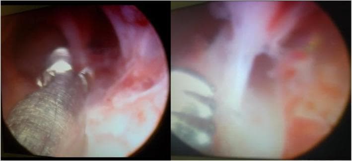 This diagnostic and interventional hysteroscopy image consists of two panels demonstrating intrauterine adhesions (Asherman syndrome) within the uterine cavity. The left panel shows the mid-uterine cavity with reddish-pink endometrial lining and whitish, fibrous tissue bands stretching across the lumen. A metallic grasping instrument with a textured surface is visible, engaging with the adhesions. The right panel provides a closer view of dense, opaque, avascular synechiae bridging the uterine walls. These adhesions partially obliterate the cavity, characteristic of moderate-to-severe intrauterine scarring. Surgical microscissors or grasping forceps are seen in the foreground, indicating the therapeutic lysis of these adhesions. The images serve to illustrate the visual appearance of fibrotic bands and the use of hysteroscopic instrumentation in the treatment of infertility related to endometrial pathology.