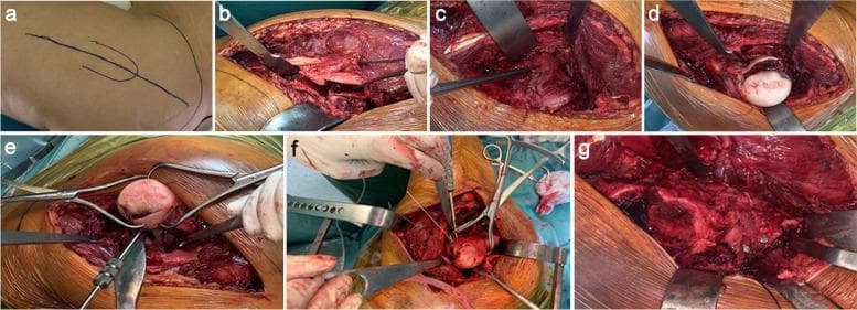 A multi-panel series of clinical photographs documenting the surgical steps of open reduction and internal fixation (ORIF) for a Pipkin type femoral head fracture via a safe surgical hip dislocation and Ganz trochanteric flip osteotomy. Panel (a) shows preoperative skin markings for the Gibson approach. Panels (b-c) demonstrate deep dissection, including the Z-shaped trochanteric osteotomy and subsequent Z-shaped capsulotomy to preserve the blood supply to the femoral head. Panel (d) reveals the exposed femoral head fracture post-dislocation. Panel (e) depicts the reduction of fracture fragments using Weber pointed reduction clamps. Panel (f) illustrates the definitive internal fixation of the femoral head using cannulated Herbert screws. The final panel (g) shows the anatomic reduction and synthesis of the greater trochanter with cortical screws. This series serves as an educational guide for orthopedic surgeons on the technique of Ganz surgical dislocation, emphasizing exposure, fragment manipulation, and stabilization in complex proximal femur trauma.