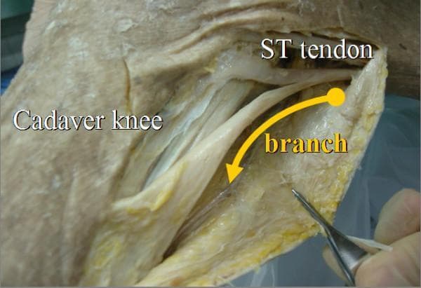 This clinical photograph shows a gross anatomical dissection of a right cadaver knee, specifically focusing on the medial aspect. The primary structure identified is the semitendinosus (ST) tendon, which appears as a prominent, white, fibrous band of connective tissue. An arrow and label highlight a secondary 'branch' of the ST tendon, which is shown diverging from the main tendon body and extending toward the gastrocnemius muscle. The dissection reveals the surrounding soft tissue, characterized by yellowish adipose tissue and fascia with a coarse texture. Surgical forceps are visible in the lower right, being used to isolate and retract the thin tendon branch. This visual demonstrates the accessory attachments of the hamstring tendons, specifically the ST branch that can be utilized as an 'inducer graft' during anterior cruciate ligament (ACL) reconstruction to facilitate tendon regeneration at the donor site. The image is an educational resource for orthopedic surgeons and medical students studying surgical anatomy and hamstring graft harvesting techniques.
