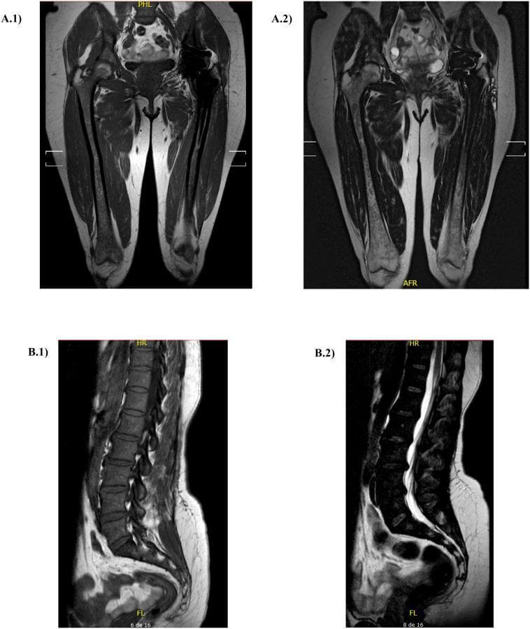 This composite diagnostic image displays magnetic resonance imaging (MRI) of the femurs and lumbar spine, used for assessing Bone Marrow Burden (BMB) in Gaucher disease. A.1 and A.2 provide coronal views of the bilateral femurs. A.1 is a T1-weighted sequence showing fatty bone marrow as high signal intensity (bright), while A.2 is a T2-weighted sequence. Significant signal loss (hypointensity) is visible within the femoral shafts and epiphyses, particularly on T1, suggesting the infiltration of Gaucher cells replacing normal fatty marrow. There is a visible asymmetry due to a left total hip arthroplasty (prosthetic replacement) which appears as a large signal void. B.1 and B.2 provide sagittal views of the lumbar spine. B.1 (T1-weighted) shows dark, heterogeneous signal intensity within the vertebral bodies, indicating diffuse marrow infiltration. B.2 (T2-weighted) illustrates the hyperintense (bright) cerebrospinal fluid (CSF) in the spinal canal, contrasting with the relatively low-signal bone marrow. These images are clinically relevant for scoring skeletal involvement and monitoring treatment response in metabolic storage disorders.