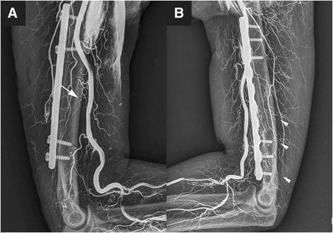 Two-panel plain radiograph (X-ray) depicting vascular perfusion of the humerus and elbow region, utilized for evaluating blood supply integrity following orthopedic surgery. Panel A shows an anteromedial view highlighting the main nutrient artery (white arrow), originating from the brachial artery and entering the mid-distal humeral shaft. Panel B demonstrates the posterior aspect, identifying multiple accessory nutrient arteries (white arrowheads) arising from the profunda brachii artery. Both images display surgical hardware in situ, including a long radiopaque metallic plate and cortical screws fixed to the humeral shaft, likely representing a Minimally Invasive Plate Osteosynthesis (MIPO) procedure. The radiographic contrast outlines the extensive arterial network, including the brachial artery and its branches, alongside the bone anatomy of the humerus, distal humerus, and proximal radius/ulna. This clinical image illustrates the vascular anatomy essential for humeral fracture healing and the impact of surgical fixation on regional perfusion.