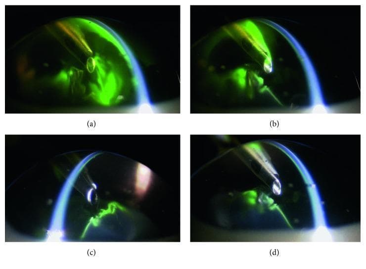 This set of four clinical slit-lamp photographs (labeled a through d) demonstrates the behavior and aspiration kinetics of a cohesive ophthalmic viscosurgical device (OVD) during a simulated cataract surgery. The OVD is stained with fluorescein (bright green) to visualize its distribution within the anterior chamber of a porcine eye model. (a) At 3 seconds post-pump activation, the cohesive OVD forms a large, concentrated mass occupying the anterior chamber. (b) At 25 seconds, the OVD maintains a similar cohesive shape, showing resistance to wash-out. (c) A cross-sectional slit-beam view highlights the proximity of the phacoemulsification tip to the OVD mass. (d) By 90 seconds, the OVD volume is significantly reduced, with remaining material concentrated near the phaco tip, demonstrating that cohesive OVDs are aspirated rapidly and entirely once engaged by the instrument. This progression illustrates the surgical handling characteristics of cohesive OVDs, which provide space maintenance but are easily removed, offering less prolonged endothelial protection compared to dispersive types.