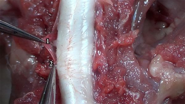 This clinical photograph captures a microsurgical dissection of the spinal meninges, demonstrating the anatomical differentiation between the dura mater and the arachnoid mater. In the center of the frame, the spinal cord appears as a prominent, whitish, cylindrical structure with visible fine vascularization on its surface. Surgical forceps are used to retract and distinguish two distinct layers: the dura mater (labeled '1') and the arachnoid mater (labeled '2'). The dura mater (1) is visualized as a thicker, more opaque, and slightly reddish fibrous membrane, reflecting its dense collagenous composition and relative resistance to manipulation. In contrast, the arachnoid mater (2) is depicted as a thinner, more translucent, and whiter membrane underlying the dura. The surrounding surgical field contains exposed paraspinal muscles and subcutaneous tissues, appearing reddish and fleshy with a glistening texture due to the presence of biological fluids. This image serves as an educational reference for neurosurgical anatomy, specifically the layered structure of the spinal meninges and the plane of dissection required to access the subarachnoid space.