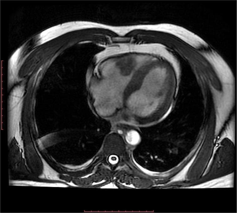 This diagnostic image is a steady-state free precession (SSFP) cardiac magnetic resonance imaging (MRI) in a four-chamber cine view. The image shows the thoracic cross-section with a clear view of the heart's anatomy. The right ventricle (RV) exhibits significant pathology characterized by apical obliteration and a heterogeneous, mass-like structure protruding into the RV cavity from the free wall. This mass is located near the apex and appears to occupy a portion of the right ventricular lumen. Additionally, a circumferential pericardial effusion is visible as a hypointense band surrounding the cardiac silhouette within the pericardial sac. Surrounding anatomical structures including the descending aorta, spinal canal, and pulmonary parenchyma are also captured in this axial-plane representation. The image serves as an educational example of cardiac masses and associated pericardial changes, demonstrating the utility of MRI in evaluating right ventricular morphology and identifying space-occupying lesions in the heart.