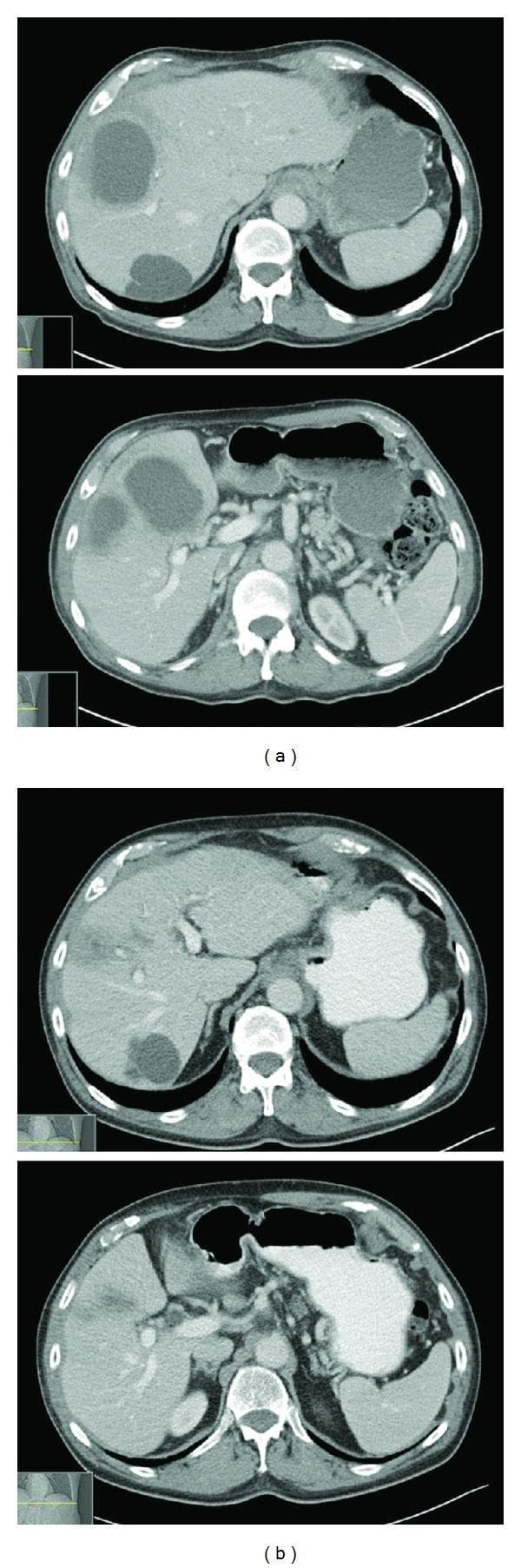 This Comparison Chart displays axial contrast-enhanced abdominal Computed Tomography (CT) scans highlighting the progression of hepatic pathology. Panel (a) illustrates pre-treatment diagnostic imaging showing multiple large, thick-walled, low-density lesions primarily localized in the right hepatic lobe. These findings are characteristic of pyogenic liver abscesses, with the largest lesion demonstrating peripheral rim enhancement and internal hypodensity. In contrast, panel (b) shows post-treatment imaging following a 6-week course of antibiotics, revealing significant radiographic resolution. The previously seen abscesses have markedly decreased in size and attenuation, with the liver parenchyma returning to a more homogeneous appearance. Notably, a simple benign liver cyst is visible in the posterior segment of the liver, which remains unchanged in size and morphology between both time points, serving as a stable anatomical landmark. The image demonstrates key concepts in hepatobiliary radiology, including the differentiation between infected fluid collections and simple cysts, as well as the radiological monitoring of treatment response in infectious diseases.