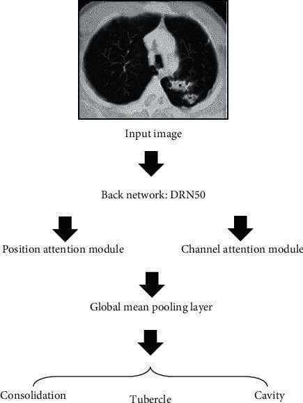 A medical flowchart detailing a deep learning diagnostic algorithm for pulmonary tuberculosis detection from computerized tomography (CT). The process begins with an 'Input image' showing an axial cross-section of the thorax, where the right lung displays a relatively healthy appearance with clear branching airways, while the left lung exhibits abnormal pathology characterized by increased opacities, mottling, and potential cavitary lesions. The image data is processed through a 'Back network: DRN50' for feature extraction. This is followed by parallel processing via a 'Position attention module' and a 'Channel attention module' to enhance spatial and feature-specific focus. These outputs are integrated at a 'Global mean pooling layer' before the final classification stage. The clinical outcomes classified by the DADRN algorithm are categorized into three primary diagnostic findings related to pulmonary tuberculosis: 'Consolidation', 'Tubercle' (nodules), and 'Cavity'. This flowchart serves as a technical overview for the application of artificial intelligence in radiological lesion localization and disease classification.