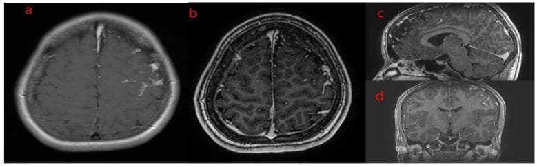 This diagnostic image composite presents brain Magnetic Resonance Imaging (MRI) from a patient with Sturge-Weber syndrome. The series includes T1-weighted sequences following gadolinium contrast administration across four views: (a) axial, (b) thin-slice axial, (c) sagittal reconstruction, and (d) coronal reconstruction. The primary finding is intense, pathological leptomeningeal enhancement localized to the left hemisphere, specifically following the gyral patterns of the frontal lobe. This enhancement represents a meningeal angioma or pial angiomatosis. In the axial views (a, b), there is a clear asymmetry compared to the right hemisphere, with contrast highlighting the deep sulci and cortical surfaces on the left. The thin-slice axial view (b) particularly emphasizes the increased vascularity and potential intracranial lipomatosis within the subarachnoid space. The sagittal (c) and coronal (d) multiplanar reconstructions further demonstrate the extent of this leptomeningeal involvement along the cortical mantle. These findings are characteristic of neurocutaneous syndromes involving vascular malformations of the pia mater.