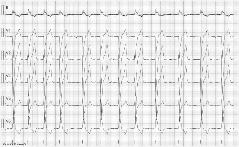 This diagnostic image displays a 6-lead electrocardiogram (ECG) featuring leads II, V1, V2, V4, V5, and V6, presented on a standard grid with a paper speed of 25 mm/s and voltage of 10 mm/mV. The tracing demonstrates an irregularly irregular rhythm that may be misinterpreted by automated software as atrial fibrillation. However, meticulous visual inspection, particularly in lead V1, reveals the presence of small, low-amplitude P waves preceding most narrow QRS complexes, which confirms an underlying sinus-based rhythm. The irregular interval between beats is attributed to premature supraventricular complexes and premature atrial contractions (PACs). Lead morphology shows a predominant R wave in the lateral precordial leads (V4–V6) and a deeper S wave in the right precordial leads (V1–V2), consistent with normal ventricular depolarization patterns. This ECG is an educational example used to highlight the importance of manual rhythm analysis in distinguishing sinus rhythm with ectopy from atrial fibrillation to avoid inappropriate clinical management such as unnecessary anticoagulation.